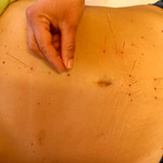 Addominoagopuntura: altre metodiche