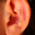 Auricoloagopuntura: altre metodiche