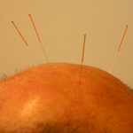 Craniopuntura: altre metodiche